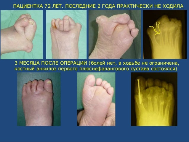 Экзастозэктомия медиального плюсне клиновидного сустава коррекция молоткообразной деформа где находится цилиндрический сустав